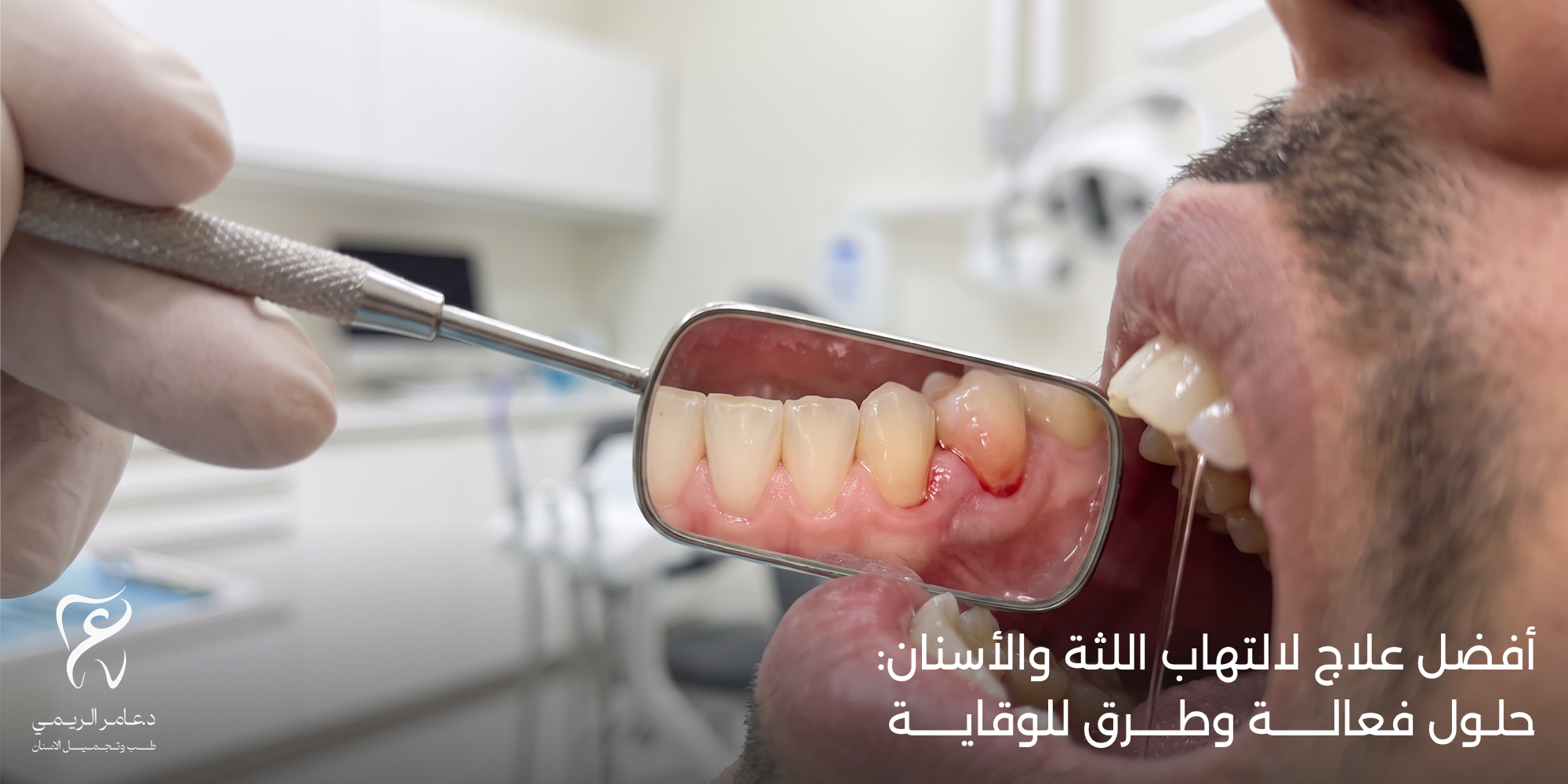 افضل علاج لالتهاب اللثه والاسنان